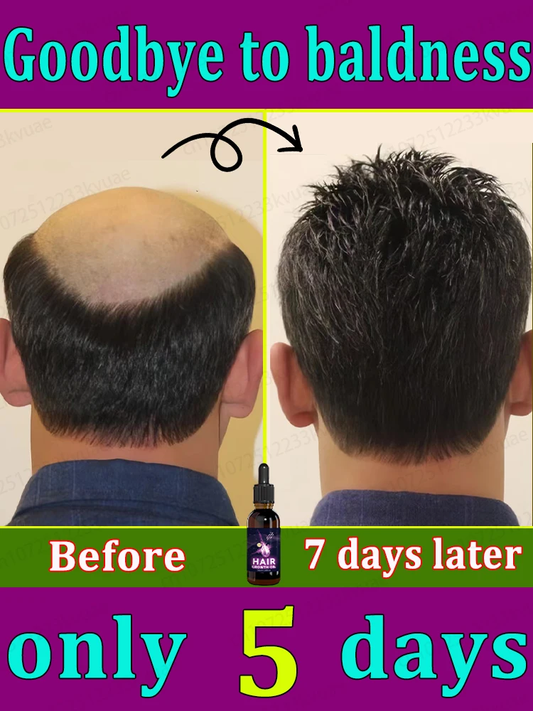 

From the moment you click on this product, you will no longer be bald or have hair loss