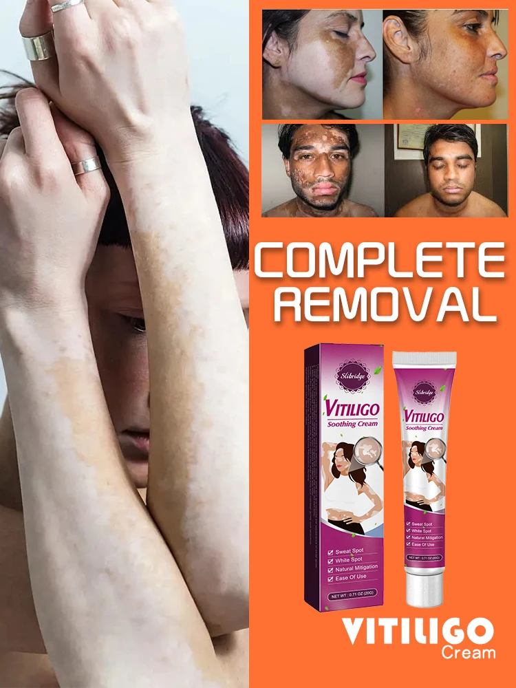 

Vitiligo ointment is effective in repairing the skin