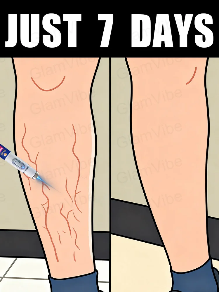 Caneta de luz azul resolve varizes, venda quente de ferramentas para cuidados com as pernas
