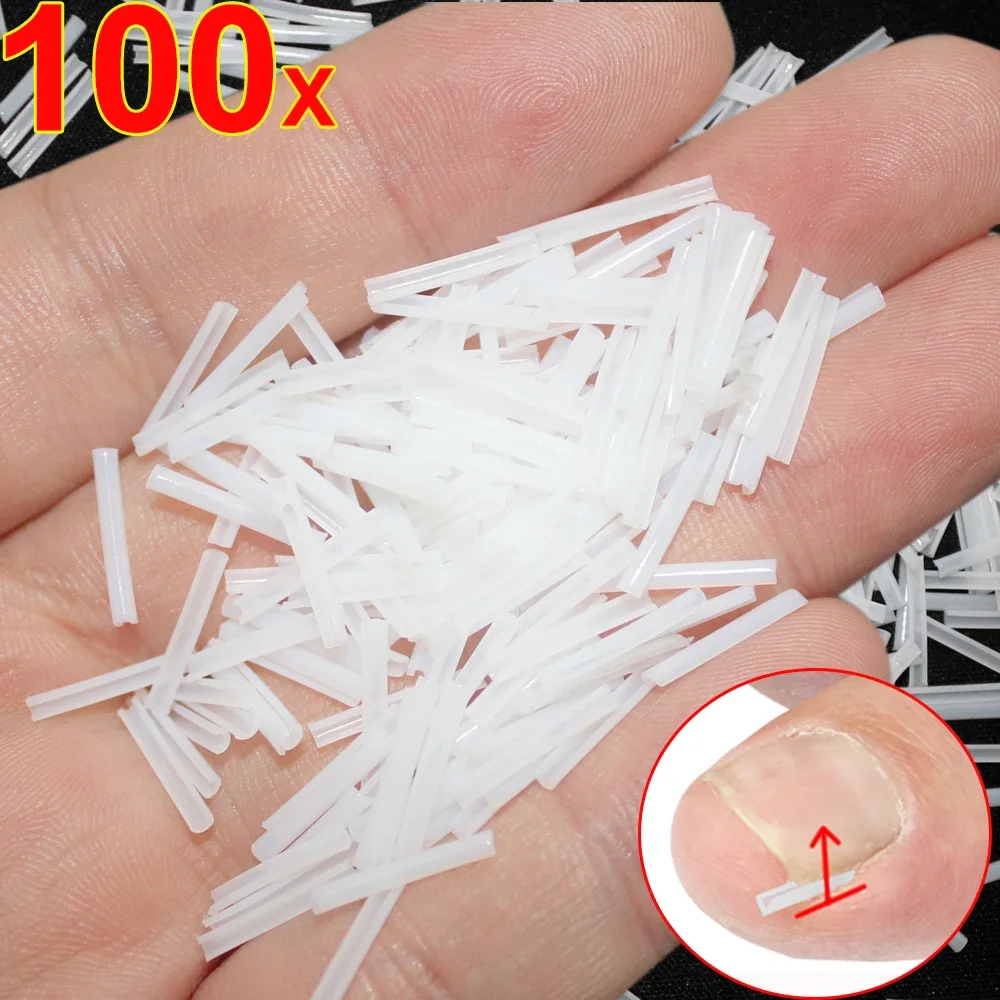 1-100PCS Ingrown Toenail Correction Ultra-thin Nail Treatment Elastic Patch Sticker Straightening Nails Groove Ingrown Corrector