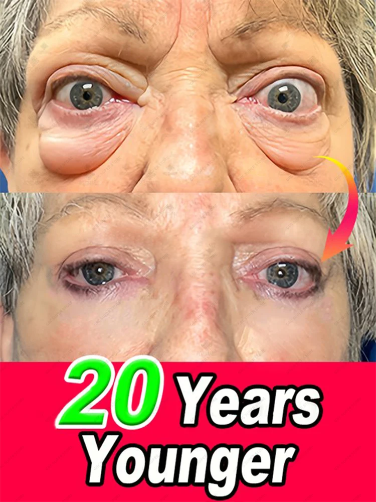 

Get rid of eye bags in just 7 days