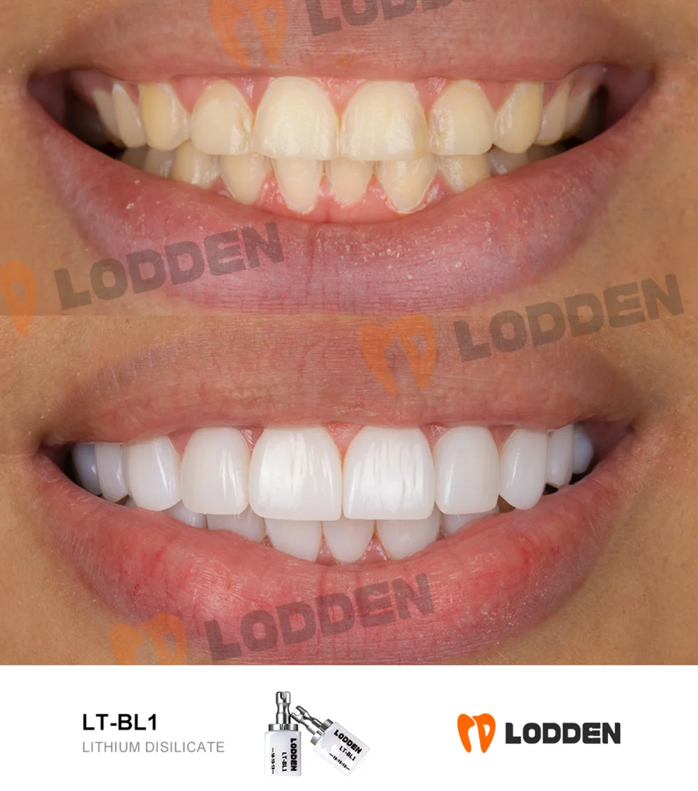 Dental Lithium Disilicate Block C14 5Pcs Dental Lab Glass Ceramic LT/HT for CAD CAM Sirona Cerec Milling System Dentist Material