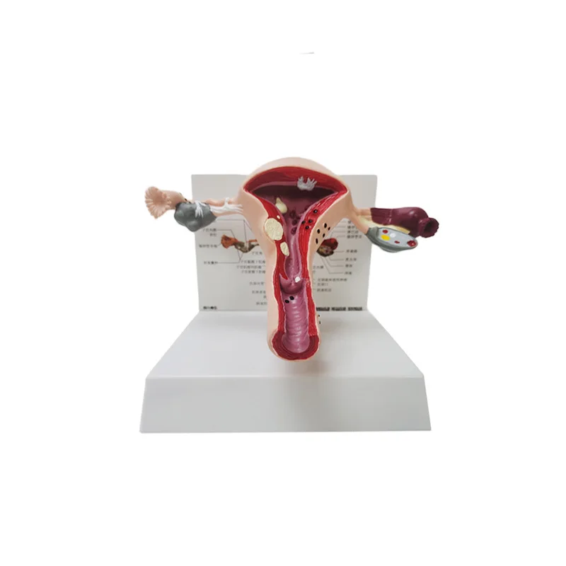 Medical Human Pathological Uterine And Ovarian Anatomical Model Gynecological Display Medical Teaching Supplies