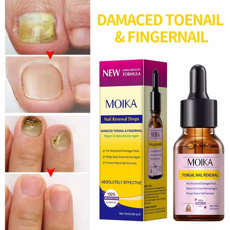 Schimmel Nagel Behandeling Serum Voet Nagel Schimmel Verwijdering Reparatie Gel Anti Infectie Paronychia Onychomycose Voet Nagels Zorg Essentie
