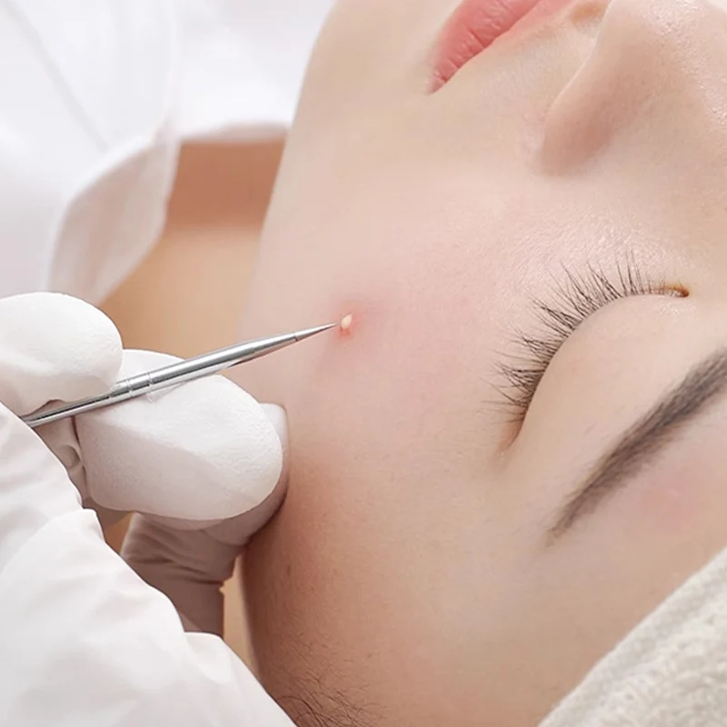 블랙헤드 제거기 5개 세트, 여드름 제거 키트, 블레미쉬, 화이트헤드 제거, 코 및 얼굴 클렌징 도구