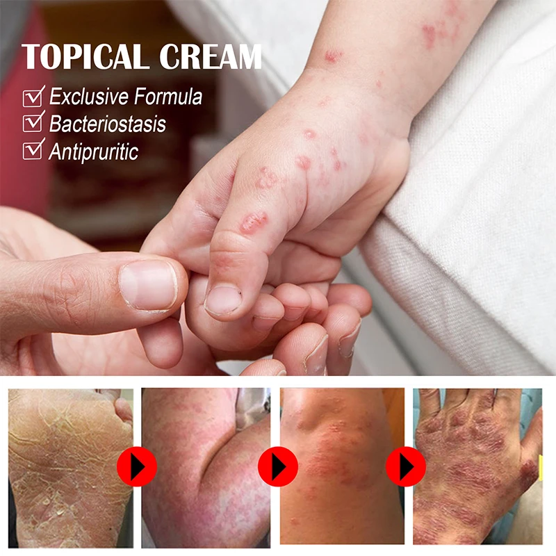 Sweat Blister Anti-itch Cream Relief Sweat Herpes Ointment Psoriasis Eczema Remove Small Blisters Hand Foot Dry Skin Itchy Care