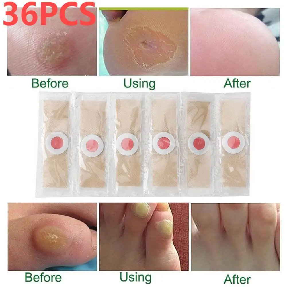 36PCS Foot Corn Removal Cream Removes Calluses And Thorns Patches Callus Soften Skin Stickers Toe Protection Pads Foot Plasters