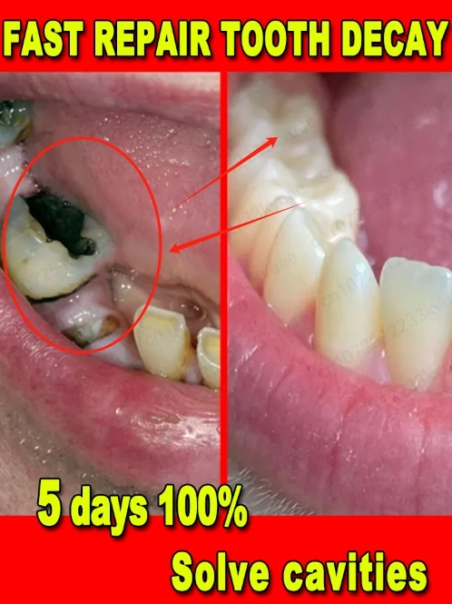 Repair cavities, Prevent tooth decay,remove plaque, toothache, whiten teeth, relieve periodontitis, freshen up bad breath