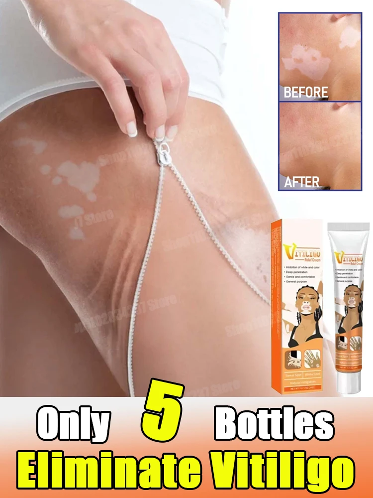 

[New] Vitiligo Cream Vitiligo Remover Tinea Versicolor Body Lotion Helps Get Rid of Sweat Spot Vitiligo, Skin Vitiligo Clear