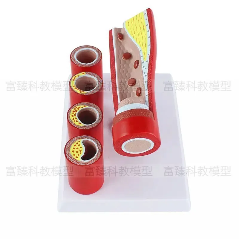 Endometrial Anatomy Of Medical Artery Model To Simulate The Pathological Changes Of Vascular Stenosis With Blood Atherosclerosis