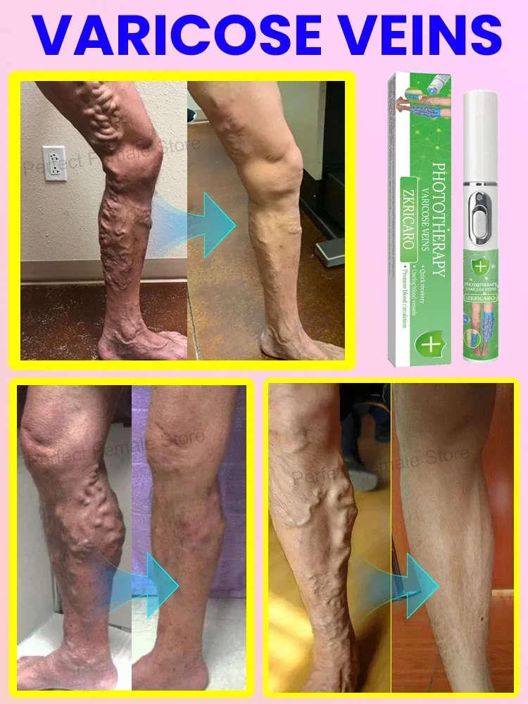 vein laser product