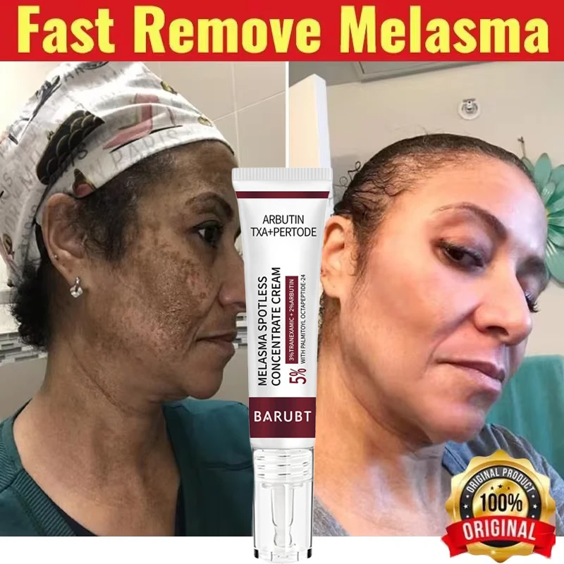 

Effective Whitening Freckle Cream Remove Dark Spot Lotion Removal Melanin Melasma Lighten Brighten Anti-Aging Skin Care Products