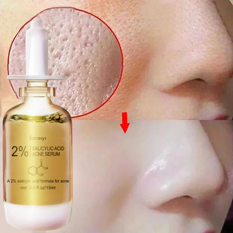 

Salicylic Acid Anti-acne Serum Reduces Acne Marks and Redness Moisturizes Shrinks Pores Smoothes Skin 30ml Facial Care Essence