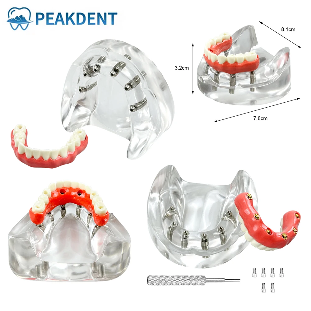 

Модель зубного имплантата, модель зубов 6, модель имплантататата, реставрация зубов, модель зубов для стоматолога, студенческого образования, модель имплантации Typodont
