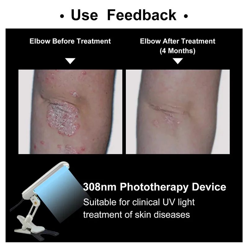 

Uv 311nm Light Therapy For Vitiligo Psoriasis Eczema Dermatitis Skin Problems Treatment uvb light 311nm vitiligo