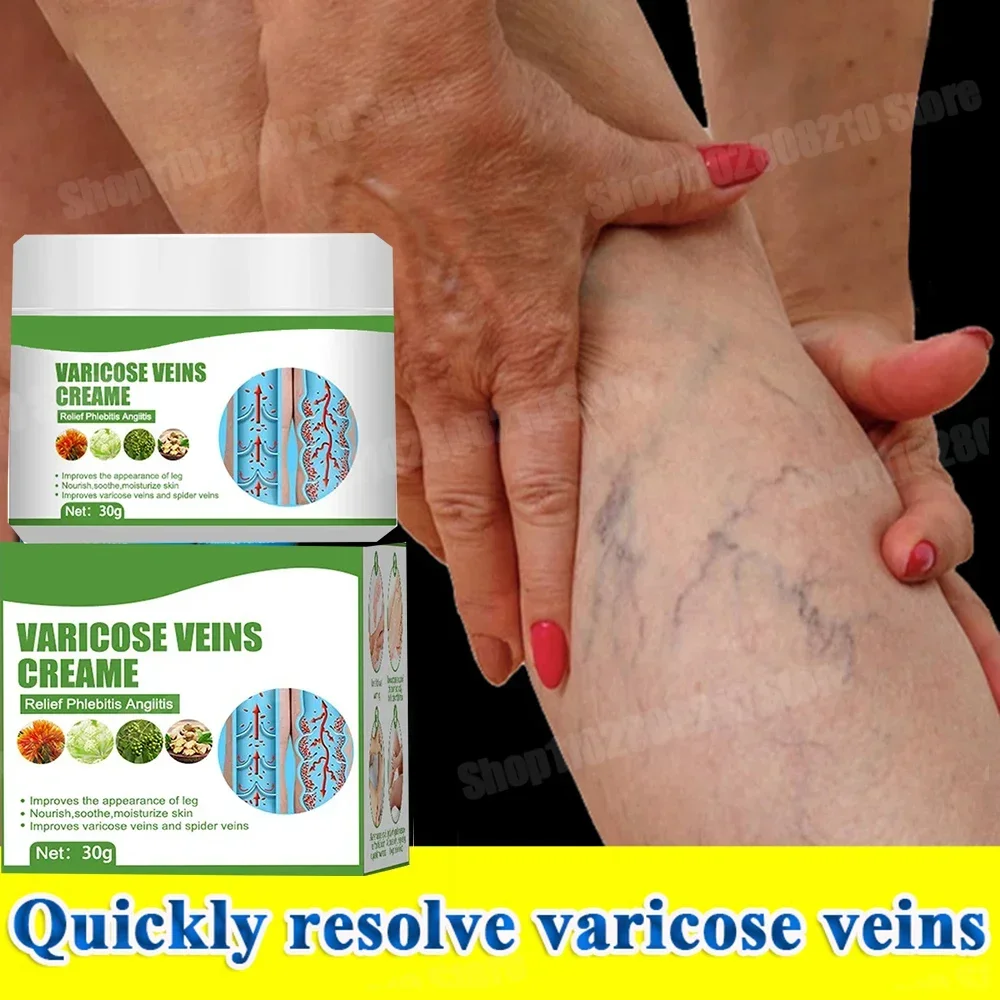 Creme de tratamento de veias varicosas, remove estrias vermelhas no sangue, varicocélula, vasculite, flebite, fortalece a saúde capilar