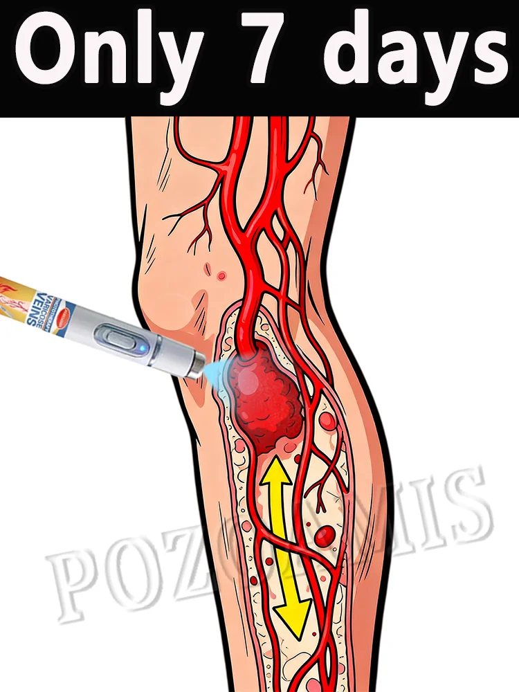 Promote blood circulation in varicose veins