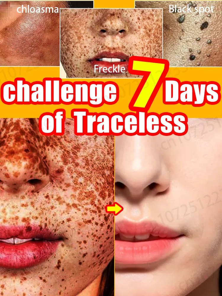 Facial freckles disappear in 7 days