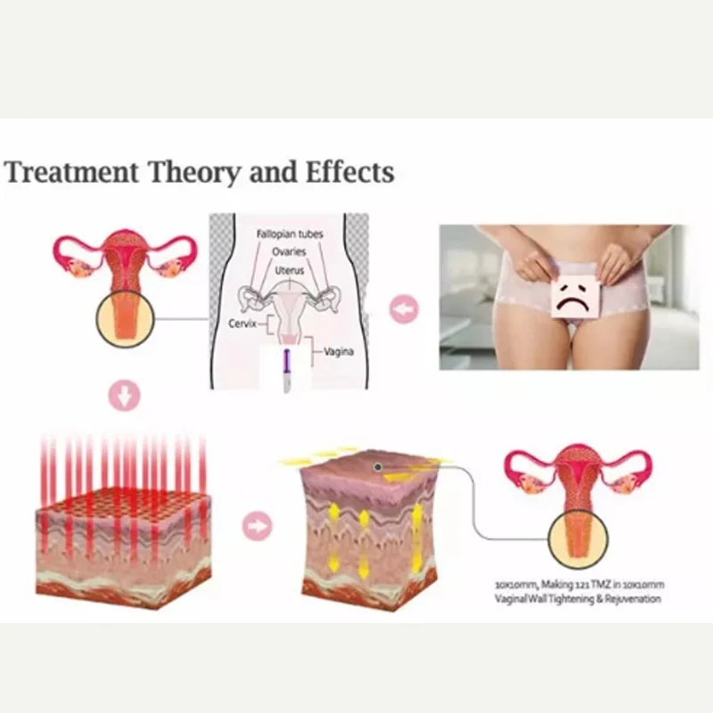 Red Light Vaginitis Therapy Machine For Feminine Hygiene Health Care