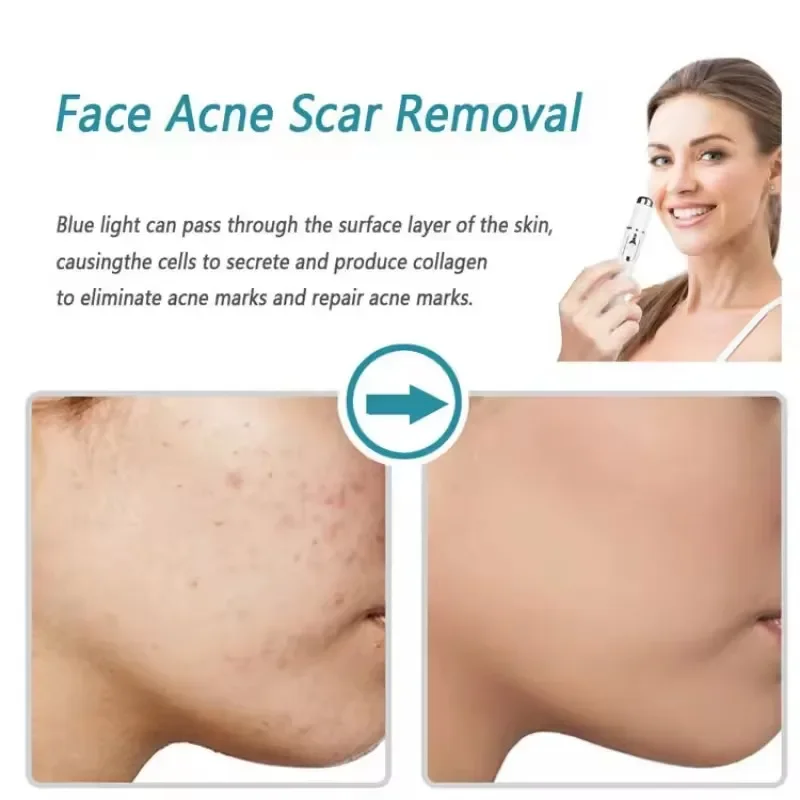 جهاز تجميل الوجه، أزرق فاتح للعين، دوائر العين السوداء، أداة العناية بالوجه، تفتيح الملمس، الحفاظ على أكياس العين #4