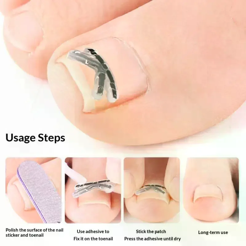 2Pcs Ingrown Toenai…