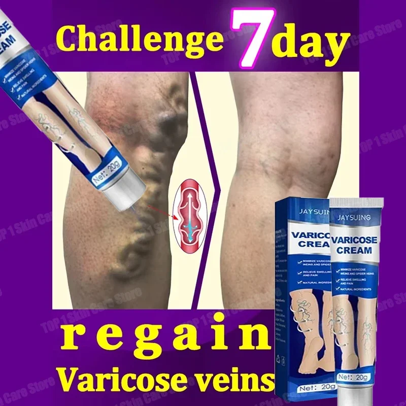 Varicose Vein Treatment for Legs | Spider Vein and Varicose Vein Cream | Collagen Protein