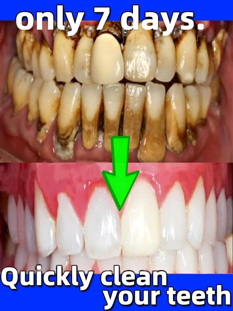 

Tartar removers dissolve tartar and remove stains quickly in 2025