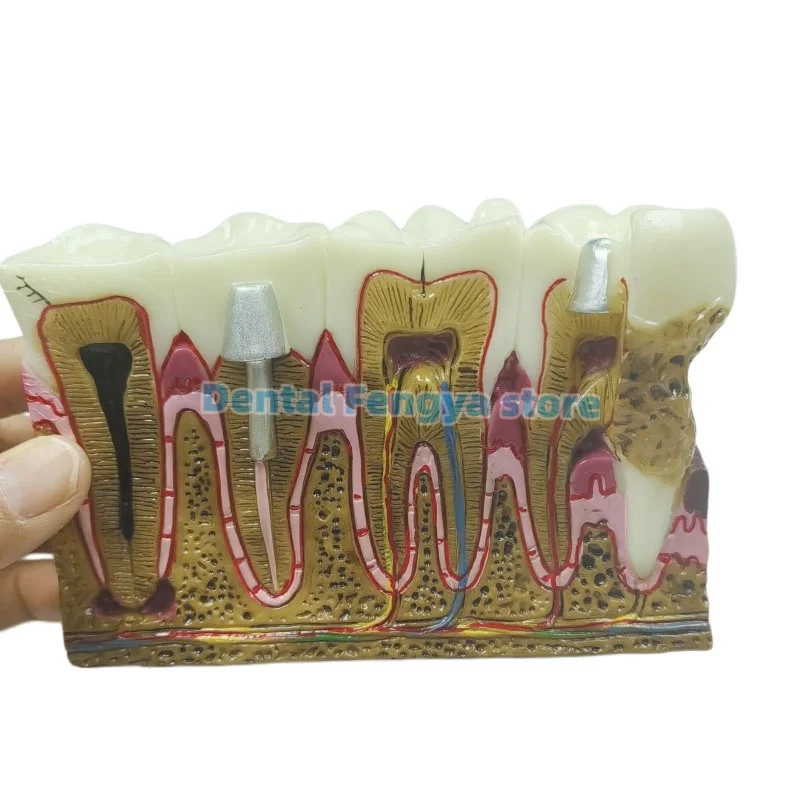 Dental M4029 Pathologies Model Dental Caries Teeth Model Dental Calculus Gingival Recession Teaching & Research Demo Model