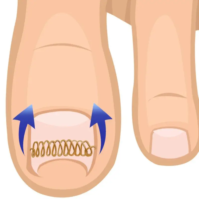 12 Stück / Box Eingewachsener Zehennagel-Korrektor Federdraht-Fixierer Pediküre-Nachrichtungsclip Patch Zehennägel Orthopädische Fußpflege – Detail 8