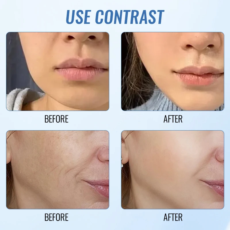 Microcorrente facial levantamento nariz ponte massageador fototerapia vibração massagem v-face raspagem nariz ponte moldar facial fino