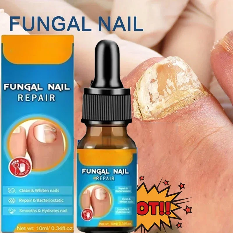 Nail Fungal Cure Nail Fungus Removal Liquid Nutritious Anti Paronychia Onychomycosis Foot Repair Fungal Nail Repair