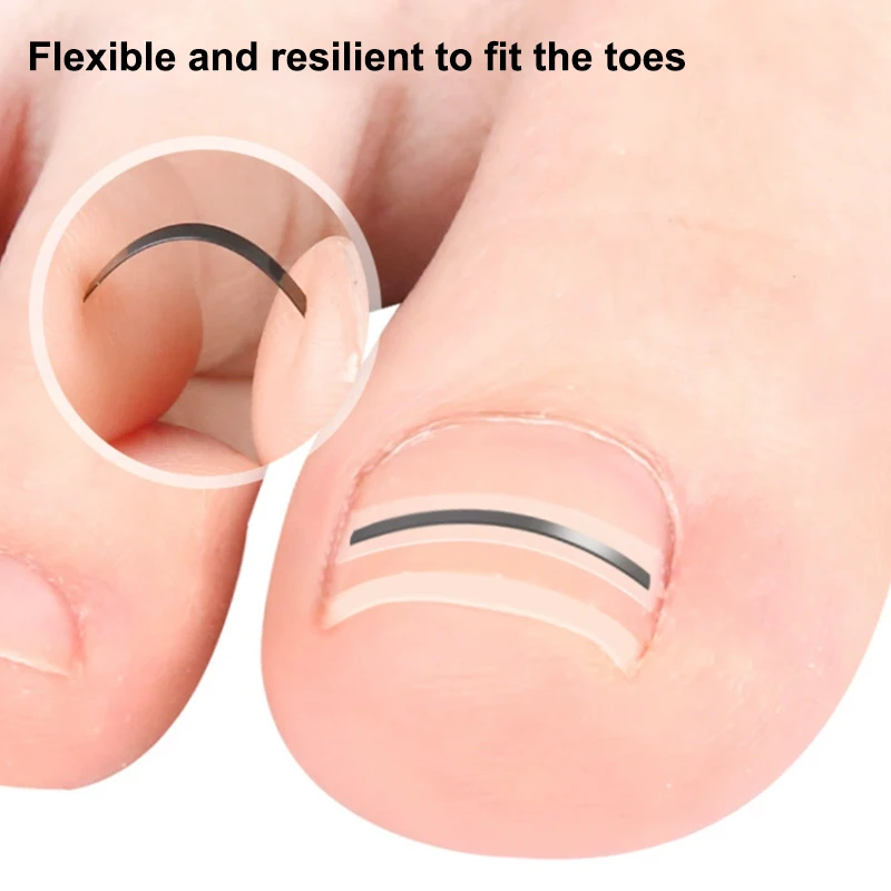 Strumento per la protezione delle dita dei piedi per la correzione dell'unghia del piede incarnita Adesivo per il trattamento delle unghie Strumento per pedicure della paronichia