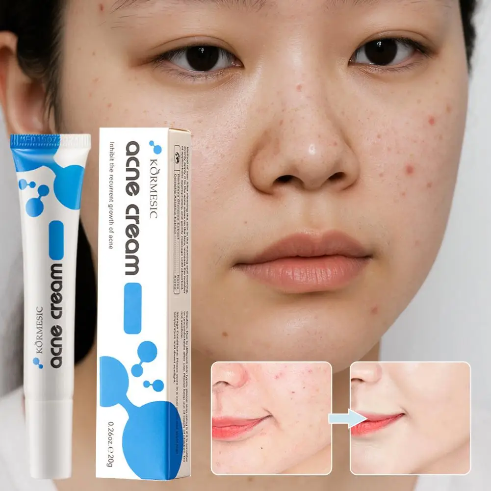 Crema para el tratamiento del acné al 20%, Gel refinador de poros antiacné para piel grasa, eliminador de espinillas, suero facial para control de grasa Cr U5V2