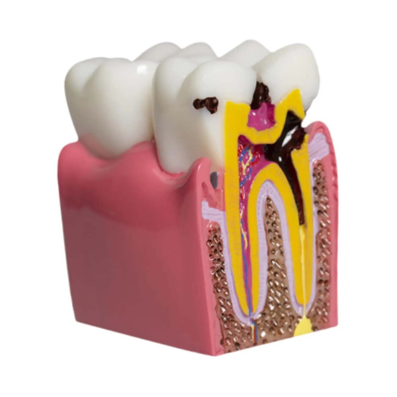 6 Times Caries Tooth Model Resin Caries Structure Detailed Teaching Aid Decay Tooth Comparative Study Model for Students Kids