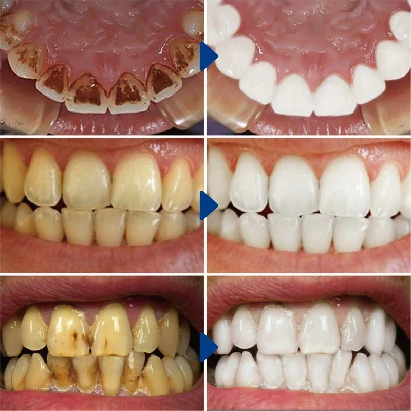 Neue Zahn aufhellung Zahn aufheller Bleichmittel Tiefen reinigung Zahn flecken entfernen Zahn aufhellung sset Reinigungs serum produkte