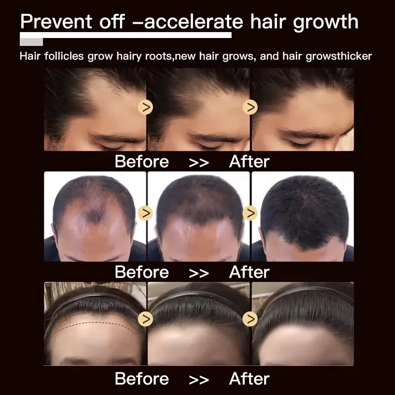 Óleo De Crescimento De Cabelo Para Homens E Mulheres, Tratamento De Perda De Cabelo, Soro De Óleo De Gengibre, Adultos