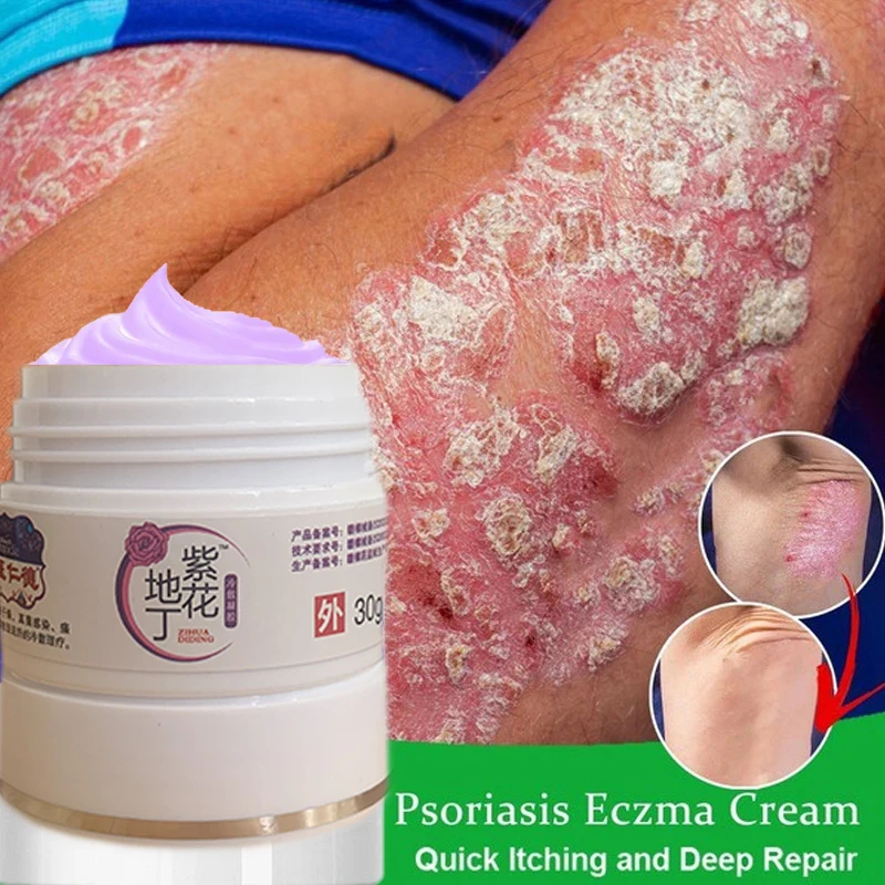 

Psoriasis Antibacterial Cream Dermatitis Eczematoid Ointment Effective Anti-Itch Chinese Herb Medical Health Skin Care Products