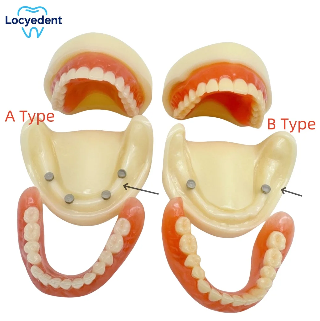 Dental Full Denture Model Overdenture Magnetic Attachment Mandibular Upper/Lower Study Teaching Model