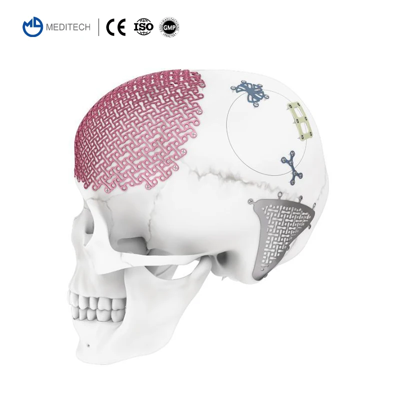 MEDITECH Orthopedic Surgical Maxillofacial Neurosurgery System Cranial Implant Titanium Mesh Plate for Skull Cranioplasty