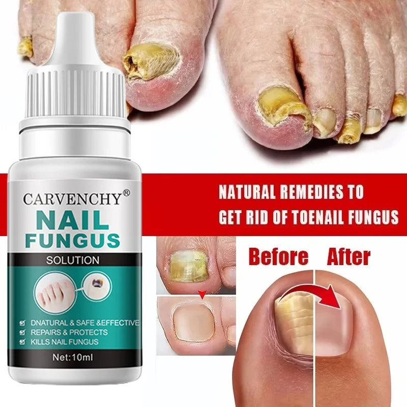 علاج الأظافر المضاد للعدوى ، المصل السائل ، مضاد للعدوى ، فطار الأظافر ، الداحس ، العناية باليد ، الأظافر والقدم ، جل إزالة الفطريات ، 10 * ، 7 أيام