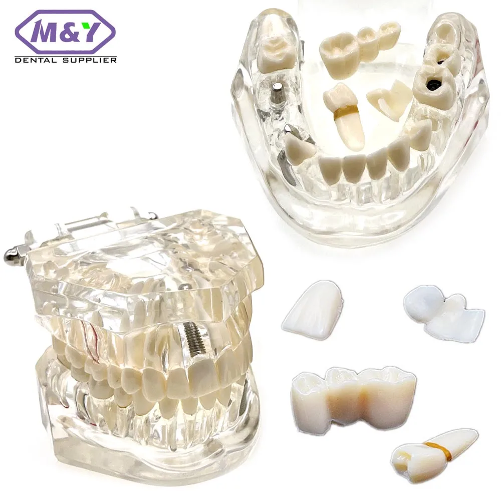 

Dental Consumable Teeth Model Medical Studying Implant Disease With Restoration Bridge Tooth Dental Teaching Model tools