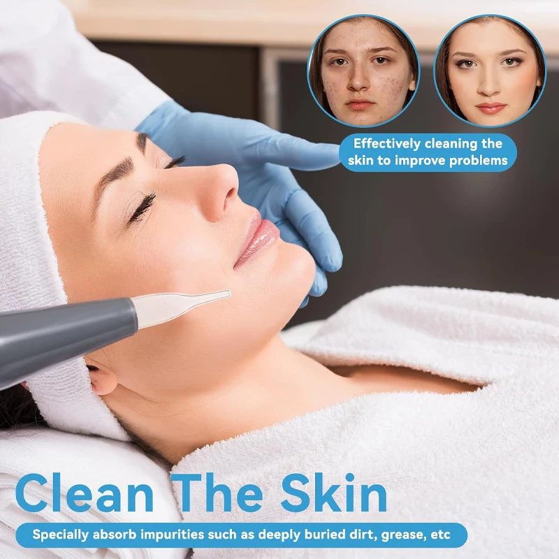 5 ชิ้นแก้วสูญญากาศเคล็ดลับอะไหล่สำหรับเครื่องกำจัดสิวหัวดำบนใบหน้าเครื่องกำจัดสิวหัวดำทำความสะอาดผิวเครื่องมือความงามรักษาสิว