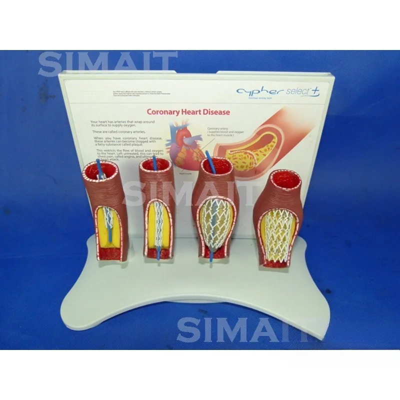 Human Vascular Blockage Stent Model, Cardiovascular and Cerebrovascular Model