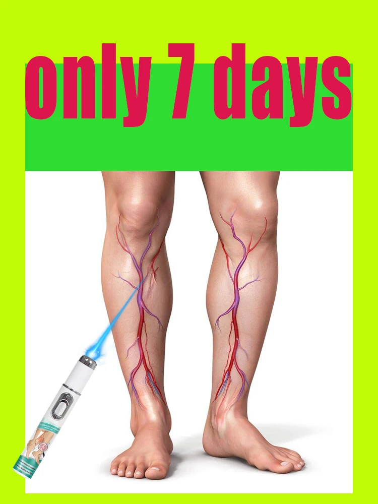 

This kind of laser therapy for varicose veins—It can help ease that leg discomfort