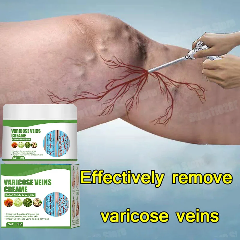 Original variceal removal cream effectively treats spider vein pain and heals it, spider vein removal