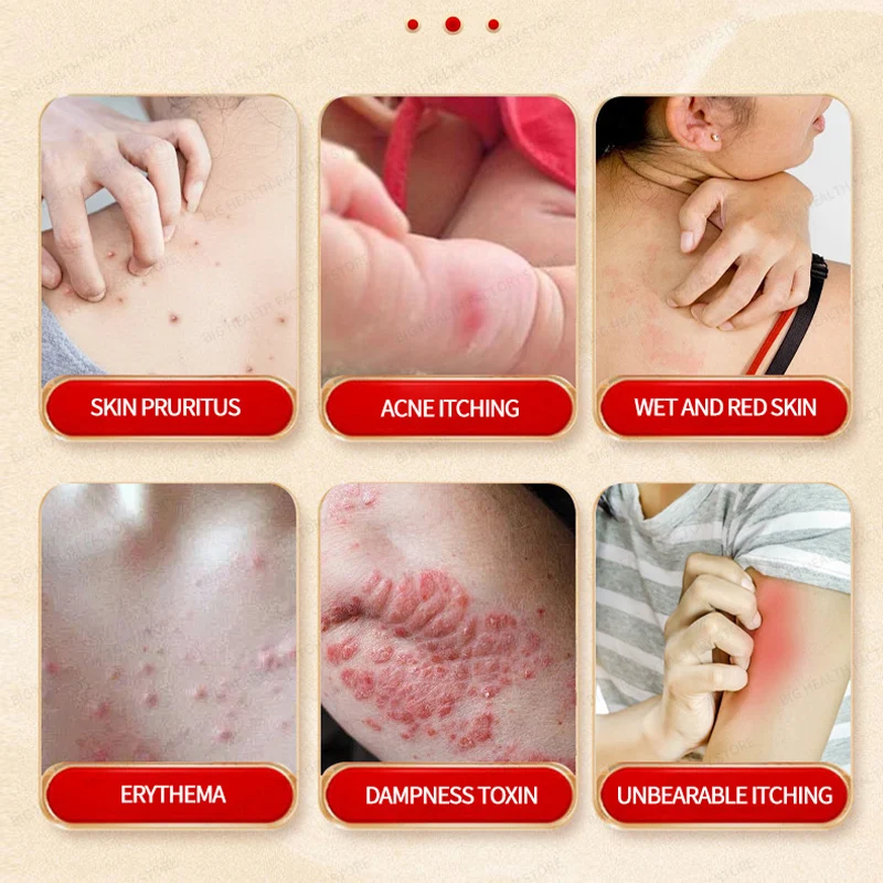 ครีมเฮอปส์เหงื่อไทยพร้อมผื่น, ผิวไม่สบาย, รอยแดง, บวม, อาการคัน, เฮอร์ปส์เหงื่อมือและเท้า, ครีมดูแลสุขภาพ