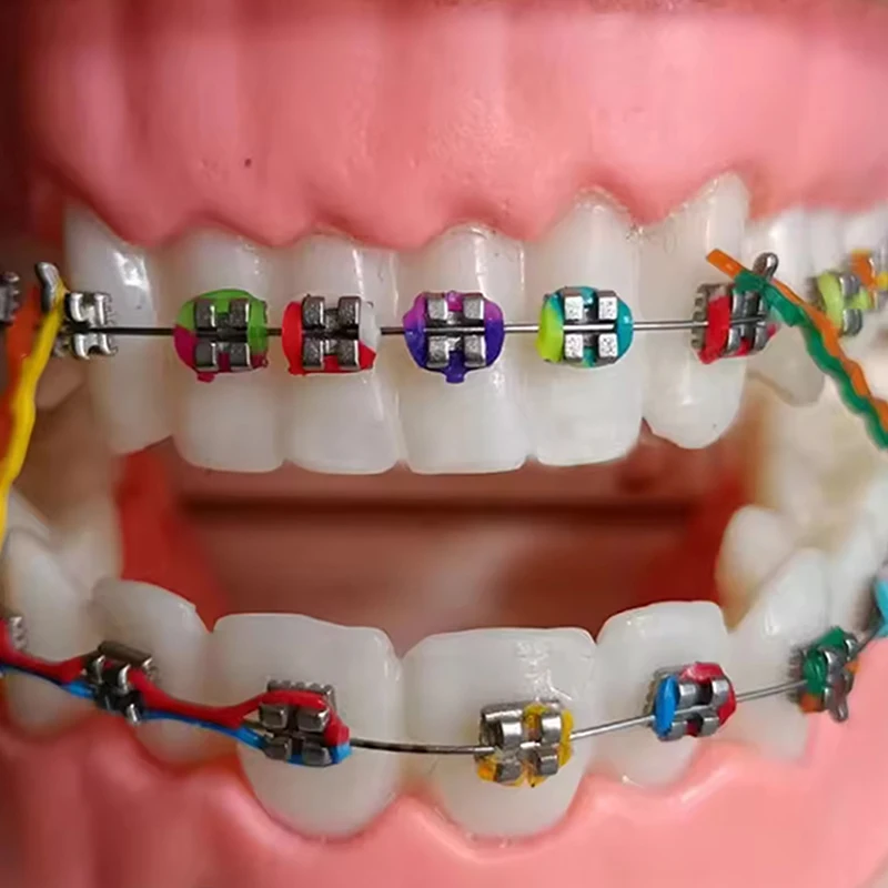 20 палочек/320 шт., стоматологические эластичные лигатуры, 3 цвета, резинки для брекетов для зубов, стоматологические эластомерные кольца, лабораторные лигатуры 20 палочек/320 шт., стоматологические эластичные лигатуры, 3 цвета, резинки для брекетов для зубов, стоматологические эластомерные кольца, лабораторные лигатуры