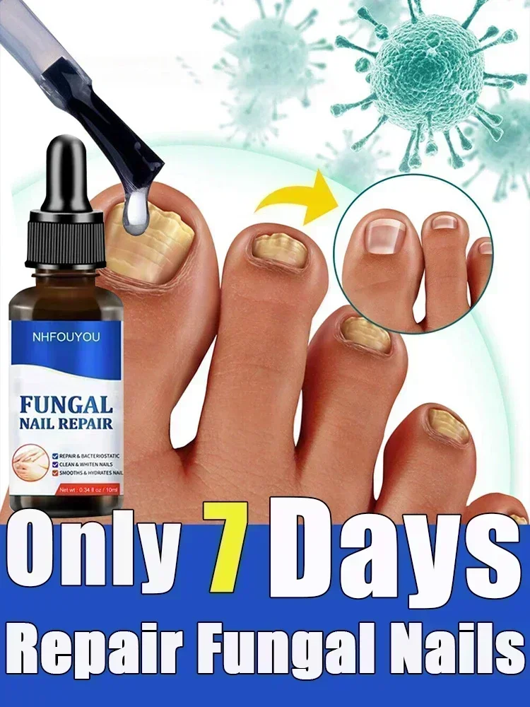 

NewFungal Nail Treatment Oil Foot Repair Essence Toe Nail Fungus Removal Gel Anti Infection Cream Fungal Nail Removal09034910