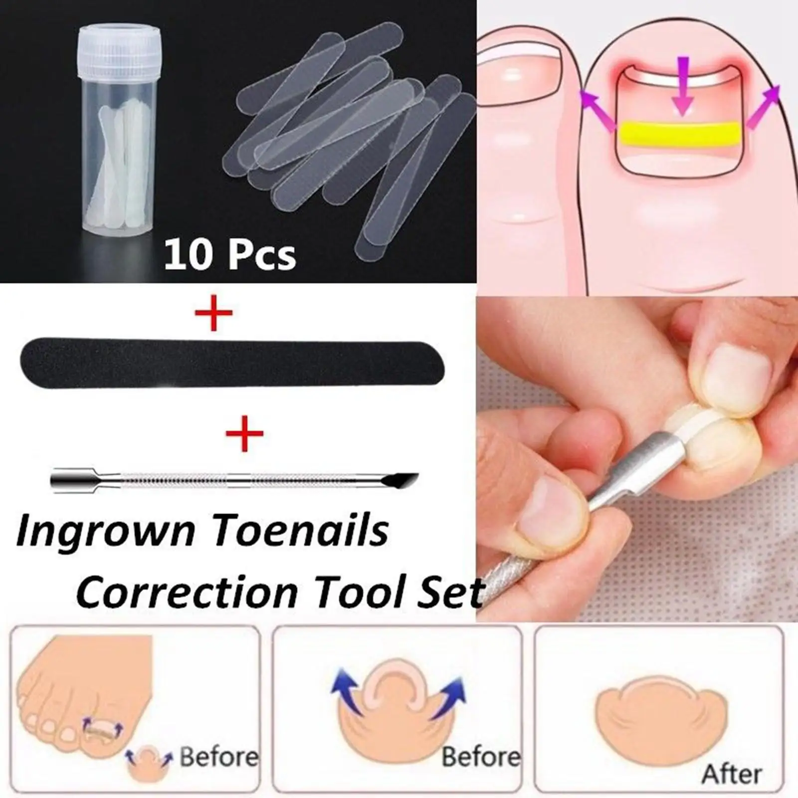 Toenail Clip Corrector Kit Plastic Nail Pusher File Accessories for Ingrown Nails Foot Treatment