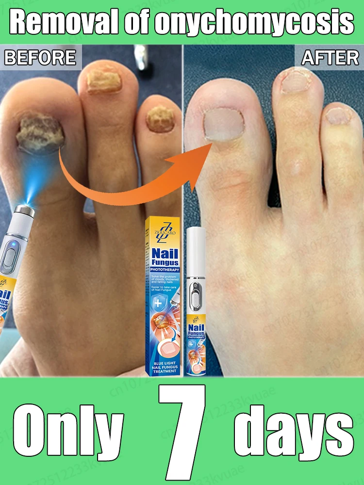 

Лазер устраняет онихомикоз, без рецидивов, без повреждения ногтей, научное удаление грибка ногтей